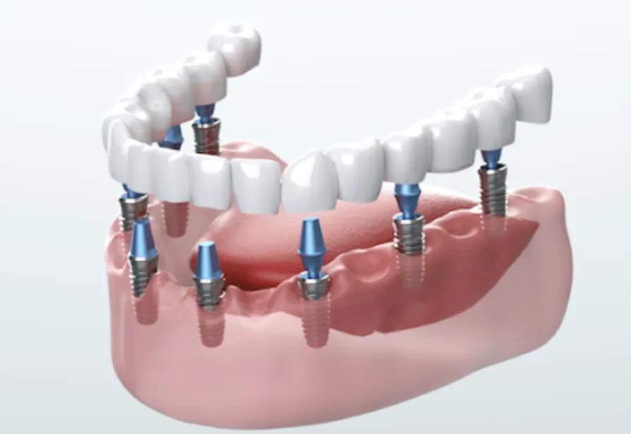 How to Get Cheap Dental Implant